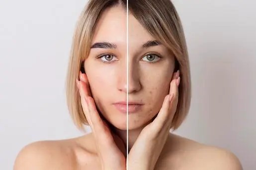 Pigmentation