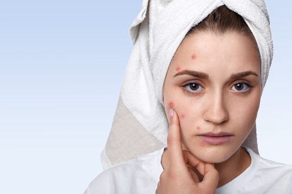 Acne Care